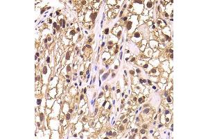 Immunohistochemistry of paraffin-embedded human kidney cancer using TCEB3 antibody (ABIN5975459) at dilution of 1/100 (40x lens). (TCEB3 抗体)
