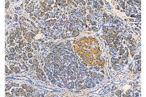 ABIN6261372 and ABIN6279351 at 1/100 staining Human pancreatic cancer and adjacent nomal tissues by IHC-P.