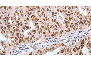 Immunohistochemistry of paraffin-embedded Human ovarian cancer tissue using Oct-6 Polyclonal Antibody at dilution 1:40 (POU3F1 抗体)