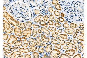 ABIN6264065 and ABIN6273288 at 1/100 staining Human kidney cancer and adjacent normal tissues by IHC-P.