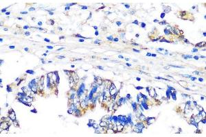 Immunohistochemistry of paraffin-embedded Human colon carcinoma using PBEF / NAMPT Polyclonal Antibody at dilution of 1:100 (40x lens). (NAMPT 抗体)