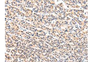 The image on the left is immunohistochemistry of paraffin-embedded Human liver cancer tissue using ABIN7131592(VPS54 Antibody) at dilution 1/20, on the right is treated with fusion protein. (VPS54 抗体)