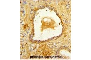 Formalin-fixed and paraffin-embedded human prostate carcinoma reacted with DAB2 Antibody (C-term), which was peroxidase-conjugated to the secondary antibody, followed by DAB staining. (DAB2 抗体  (C-Term))