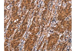 The image on the left is immunohistochemistry of paraffin-embedded Human gastric cancer tissue using ABIN7192526(SLC8A2 Antibody) at dilution 1/15, on the right is treated with synthetic peptide. (SLC8A2 抗体)