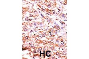Formalin-fixed and paraffin-embedded human hepatocellular carcinoma tissue reacted with GUCY1A2 polyclonal antibody  , which was peroxidase-conjugated to the secondary antibody, followed by AEC staining. (GUCY1A2 抗体  (N-Term))