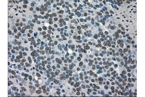 Immunohistochemical staining of paraffin-embedded Adenocarcinoma of breast tissue using anti-SOD1 mouse monoclonal antibody. (SOD1 抗体)
