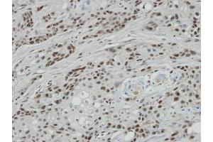 IHC-P Image Immunohistochemical analysis of paraffin-embedded oral CA cell lines Ca922 xenograft, using BCL7A, antibody at 1:100 dilution. (BCL7A 抗体  (C-Term))