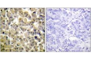 Immunohistochemistry analysis of paraffin-embedded human breast carcinoma, using MSK1 (Phospho-Ser360) Antibody. (MSK1 抗体  (pSer360))