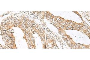 Immunohistochemistry of paraffin-embedded Human colorectal cancer tissue using SLC5A1 Polyclonal Antibody at dilution of 1:80(x200) (SLC5A1 抗体)