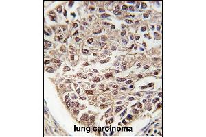 Formalin-fixed and paraffin-embedded human lung carcinoma tissue reacted with SFRS2 antibody (N-term), which was peroxidase-conjugated to the secondary antibody, followed by DAB staining. (SRSF2 抗体  (N-Term))
