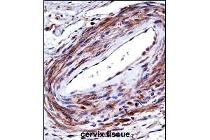 P2RX5 Antibody (C-term) ((ABIN657980 and ABIN2846926))immunohistochemistry analysis in formalin fixed and paraffin embedded human cervix tissue followed by peroxidase conjugation of the secondary antibody and DAB staining.