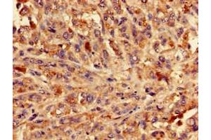 Immunohistochemistry of paraffin-embedded human melanoma using ABIN7154332 at dilution of 1:100 (BLZF1 抗体  (AA 11-99))