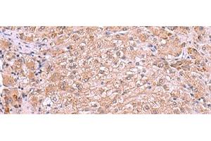 Immunohistochemistry of paraffin-embedded Human liver cancer tissue using RIC3 Polyclonal Antibody at dilution of 1:90(x200) (RIC3 抗体)