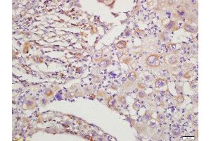 Formalin-fixed and paraffin embedded human lung cancer labeled with Rabbit Anti-RAC1+RAC2 Polyclonal Antibody, Unconjugated  at 1:200 followed by conjugation to the secondary antibody and DAB staining (RAC1 抗体  (AA 101-192))