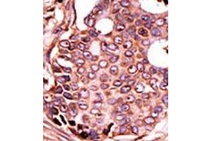 Formalin-fixed and paraffin-embedded human cancer tissue (breast carcinoma) reacted with the primary antibody, which was peroxidase-conjugated to the secondary antibody, followed by DAB staining. (SEPHS2 抗体  (Middle Region))