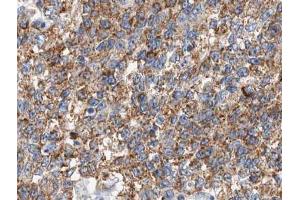 ABIN6266637 at 1/100 staining human lung carcinoma tissue sections by IHC-P. (CSTB 抗体  (C-Term))