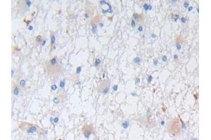 Detection of NES in Human Glioma Tissue using Polyclonal Antibody to Nestin (NES) (Nestin 抗体  (AA 178-399))