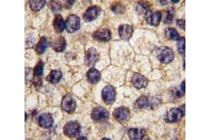IHC analysis of FFPE human prostate carcinoma tissue stained with PDGFR alpha antibody (PDGFRA 抗体  (AA 740-769))