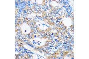 Immunohistochemistry of paraffin-embedded Human colon carcinoma using PEBP4 Rabbit pAb (ABIN7269280) at dilution of 1:100 (40x lens). (PEBP4 抗体)