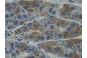 Detection of MMP7 in Human Liver cancer Tissue using Polyclonal Antibody to Matrix Metalloproteinase 7 (MMP7) (MMP7 抗体  (AA 1-267))