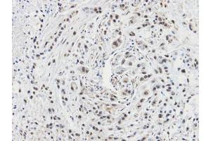 IHC-P Image Immunohistochemical analysis of paraffin-embedded A549 xenograft, using CacyBP, antibody at 1:100 dilution. (CACYBP 抗体  (C-Term))
