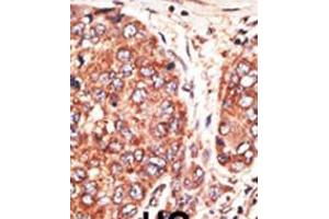 Formalin-fixed and paraffin-embedded human cancer tissue reacted with the primary antibody, which was peroxidase-conjugated to the secondary antibody, followed by AEC staining. (Septin 9 抗体  (C-Term))