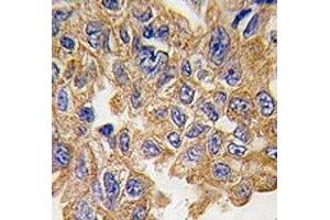 IHC analysis of FFPE human lung carcinoma tissue stained with AKT2 antibody (AKT2 抗体  (AA 452-481))