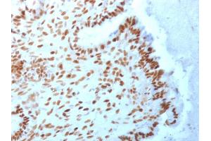 Formalin-fixed, paraffin-embedded human Endometrial Carcinoma stained with TLE1 Mouse Monoclonal Antibody (TLE1/2062). (TLE1 抗体  (AA 175-338))