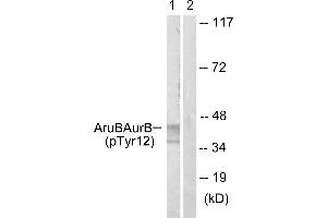 Immunohistochemistry analysis of paraffin-embedded human liver carcinoma tissue using AurB (Phospho-Tyr12) antibody. (Aurora Kinase B 抗体  (pTyr12))