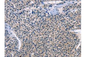 The image on the left is immunohistochemistry of paraffin-embedded Human liver cancer tissue using (LRRK2 Antibody) at dilution 1/30, on the right is treated with fusion protein. (LRRK2 抗体)
