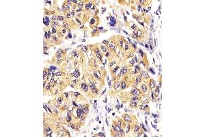 Immunohistochemistry (Paraffin-embedded Sections) (IHC (p)) image for anti-Platelet Derived Growth Factor Receptor alpha (PDGFRA) (AA 698-727) antibody (ABIN392024)