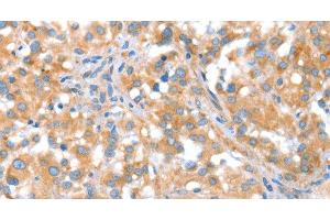 Immunohistochemistry of paraffin-embedded Human thyroid cancer tissue using ST14 Polyclonal Antibody at dilution 1:70 (ST14 抗体)