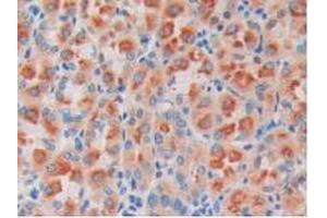 IHC-P analysis of Human Stomach Cancer Tissue, with DAB staining. (ODC1 抗体  (AA 15-259))