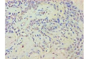 Immunohistochemistry of paraffin-embedded human breast cancer using ABIN7152359 at dilution of 1:100 (EYA2 抗体  (AA 1-514))