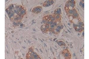 Detection of CYCS in Human Breast cancer Tissue using Polyclonal Antibody to Cytochrome C (CYCS)