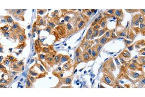 Immunohistochemistry of paraffin-embedded Human lung cancer using IGF2BP1 Polyclonal Antibody at dilution of 1:40 (IGF2BP1 抗体)