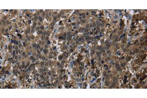 Immunohistochemistry of paraffin-embedded Human liver cancer using GSTA3 Polyclonal Antibody at dilution of 1:30 (GSTA3 抗体)