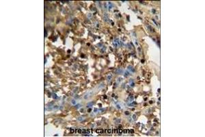 D antibody (C-term) (ABIN654936 and ABIN2844579) immunohistochemistry analysis in formalin fixed and paraffin embedded human breast carcinoma followed by peroxidase conjugation of the secondary antibody and DAB staining. (FAM20C 抗体  (C-Term))