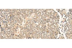 Immunohistochemistry of paraffin-embedded Human lung cancer tissue using NIP7 Polyclonal Antibody at dilution of 1:50(x200) (NIP7 抗体)