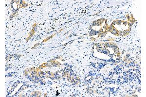 ABIN6263291 and ABIN6266590 at 1/100 staining Human lung cancer by IHC-P. (MMP11 抗体  (N-Term))