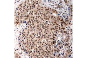Immunohistochemistry of paraffin-embedded human breast carcinoma using Phospho-MAPKAPK2-T334 antibody (ABIN2988148). (MAPKAP Kinase 2 抗体  (pThr334))