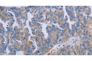 Immunohistochemistry of paraffin-embedded Human ovarian cancer tissue using P2RY2 Polyclonal Antibody at dilution of 1:40 (P2RY2 抗体)