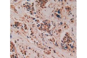 Used in DAB staining on fromalin fixed paraffin- embedded breast cancer tissue