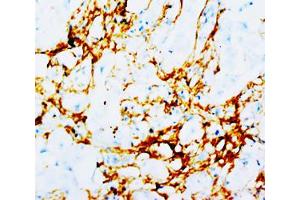 Immunohistochemical staining of human mammary cancer tissue with TNN monoclonal antibody, clone T20  at 2-4 ug/ml. (Tenascin N 抗体)
