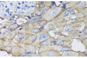 Immunohistochemistry of paraffin-embedded Human mammary cancer using CEACAM5 Monoclonal Antibody at dilution of 1:100 (40x lens). (CEACAM5 抗体)