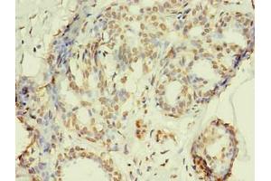 Immunohistochemistry of paraffin-embedded human breast cancer using ABIN7168449 in 30 μg/mL dilute concentrations. (RRM1 抗体)
