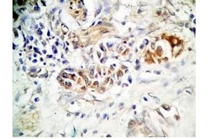 Human stomach cancer tissue was stained by rabbit anti-Spexin(H) Antiserum (Spexin 抗体)