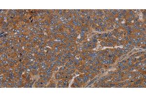 Immunohistochemistry of paraffin-embedded Human ovarian cancer using GDF2 Polyclonal Antibody at dilution of 1:40 (GDF2 抗体)