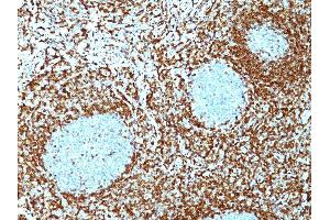 Formalin-fixed, paraffin-embedded non-Hodgkin's lymphoma stained with Bcl-2 Mouse Monoclonal Antibody (100/D5 + 124).
