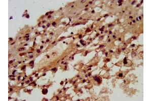 IHC image of ABIN7170595 diluted at 1:300 and staining in paraffin-embedded human melanoma performed on a Leica BondTM system. (SKA3 抗体  (AA 101-195))